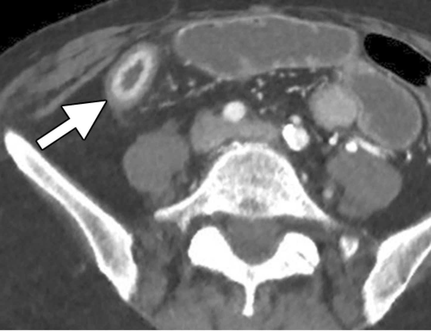 Low-dose CT enterographic study performed in a patient with Crohn disease